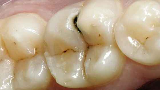 Передаются ли по наследству зубы