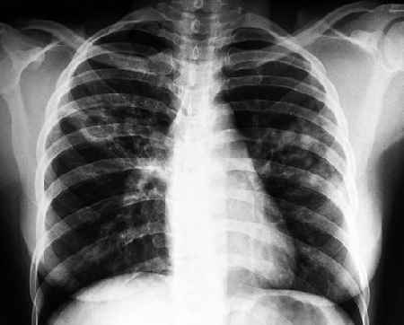 Предрасположенность к туберкулезу передается по наследству